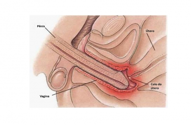 Dispareunia – O que é?